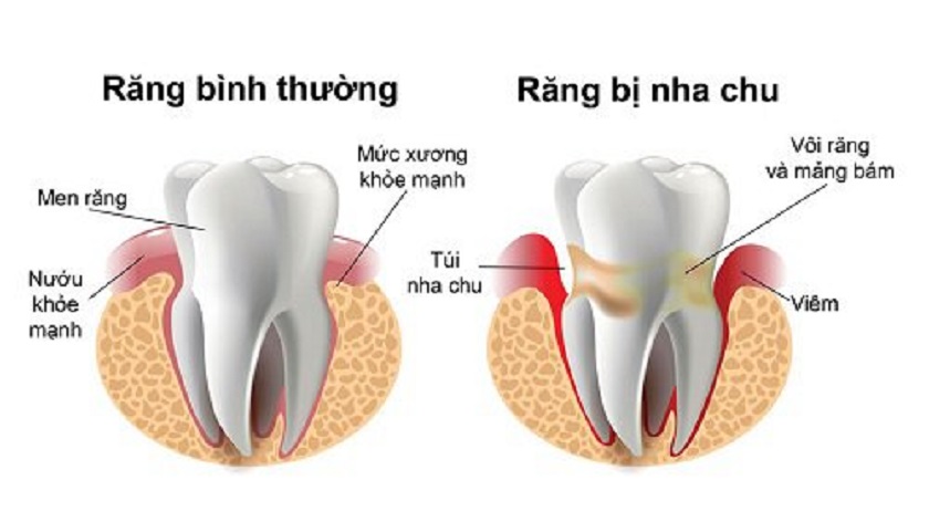 Định nghĩa về bệnh nha chu