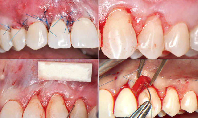 Bệnh nha chu có nguy hiểm không?