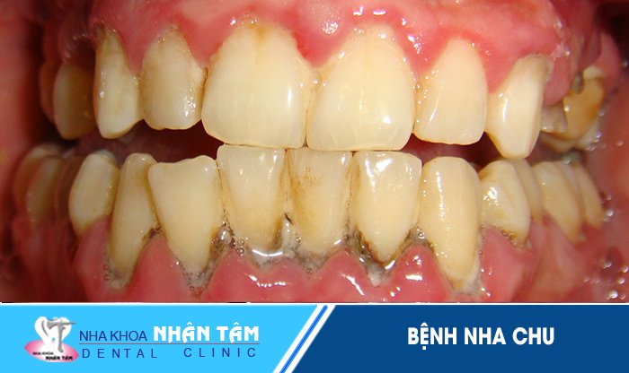 Bệnh nha chu là gì? Nguy hiểm không? Nguyên nhân gây bệnh