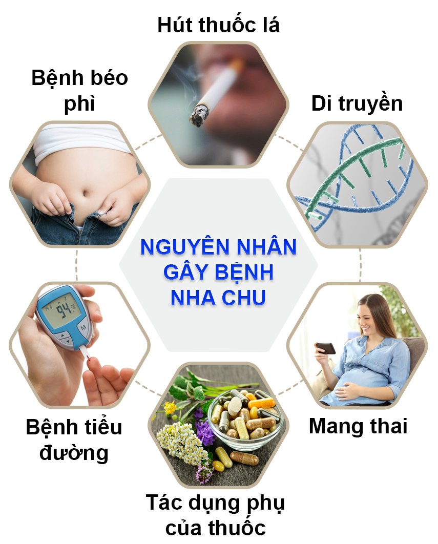 Những nguyên nhân chính gây bệnh nha chu