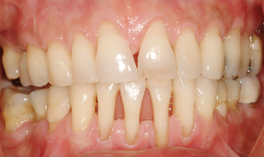 Bệnh nha chu nguy hiểm thế nào?