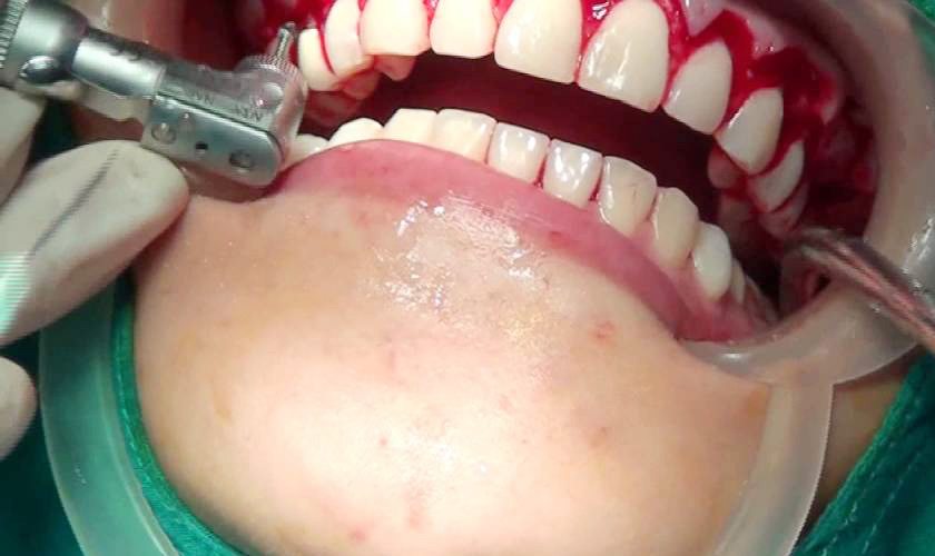 Bệnh nha chu: Nguyên nhân, biểu hiện, chẩn đoán và điều trị