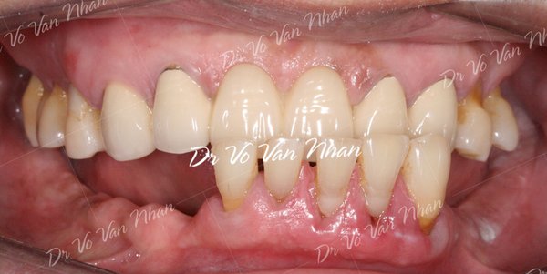 Sâu răng, tụt nướu và tiêu xương ở bệnh nhân nha chu