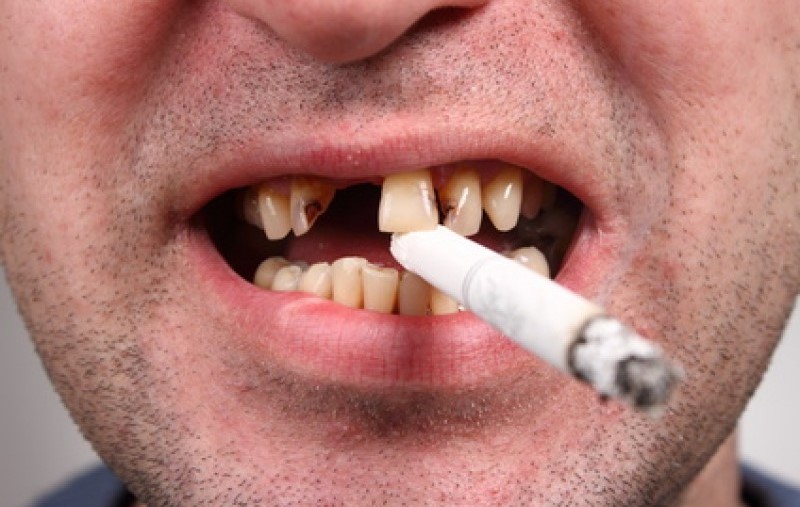 Hút thuốc lá là một trong những nguyên nhân gây ra bệnh viêm nha chu