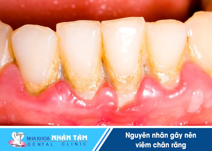 Mảng bám tích tụ lâu ngày nếu không được làm sạch sẽ dẫn đến bệnh viêm chân răng