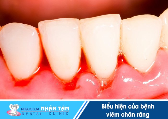 Chảy máu chân răng là một trong những biểu hiện dễ thấy của bệnh viêm chân răng