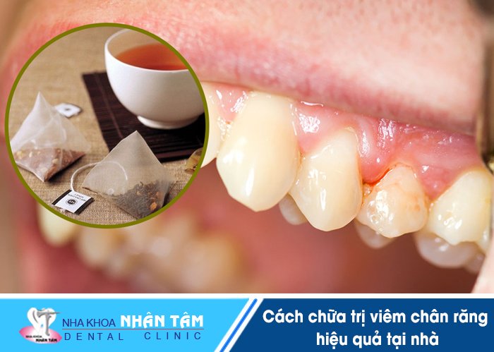 Bệnh viêm chân răng và cách điều trị