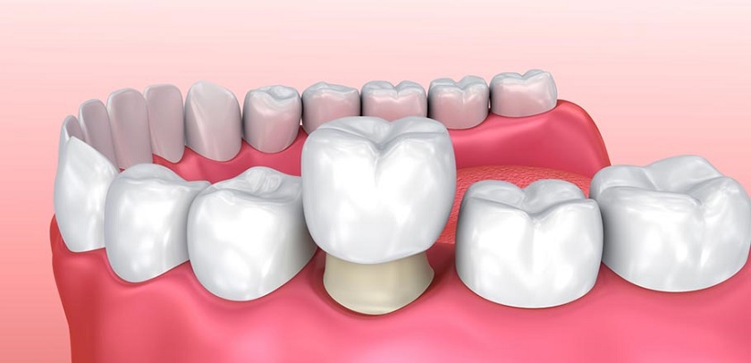 Yếu tố ảnh hưởng đến chi phí bọc răng sứ tại nha khoa