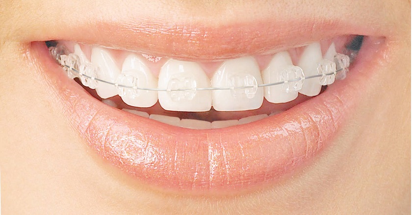 Niềng răng bằng mắc cài sứ