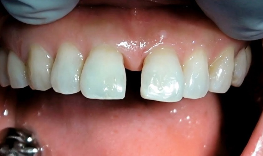 Làm thế nào để chăm sóc răng sau khi điều trị răng thưa tại nhà?
