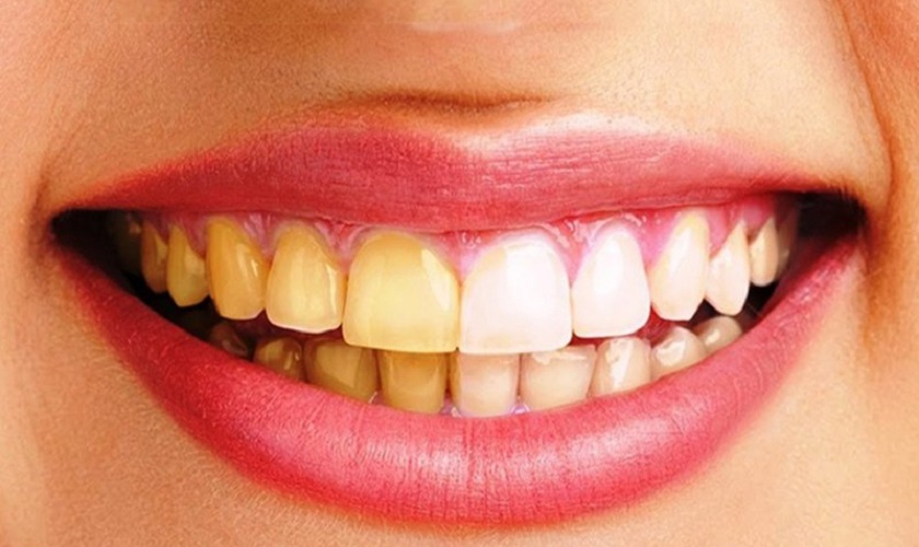 Cách làm trắng răng bị vàng tại nhà và tại nha khoa