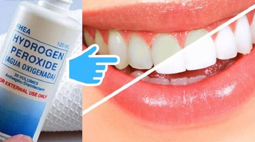 Dùng oxy già để cải thiện mảng bám