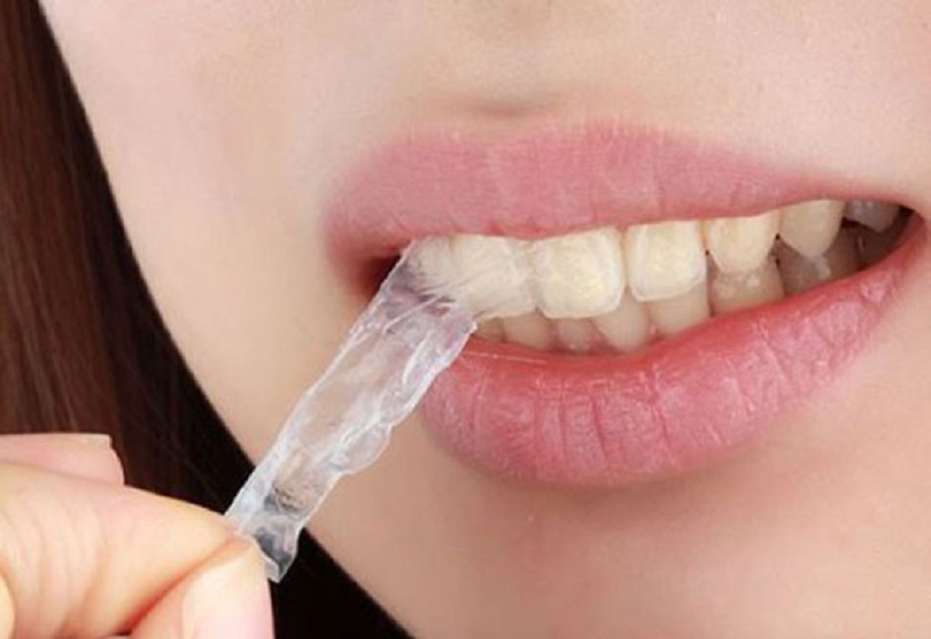 Chú ý khi sử dụng miếng dán trắng răng là gì