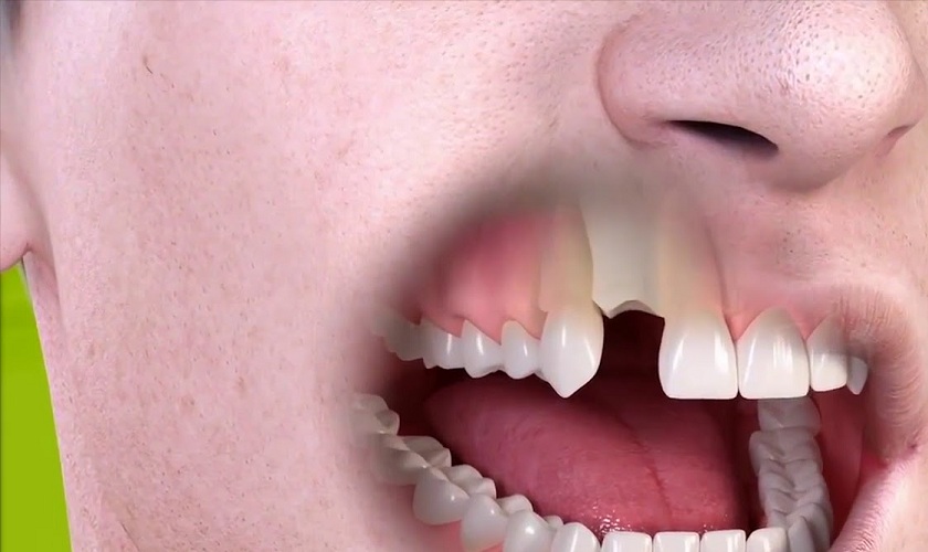 Cần biết: Trồng răng Implant ở đâu tốt TPHCM?