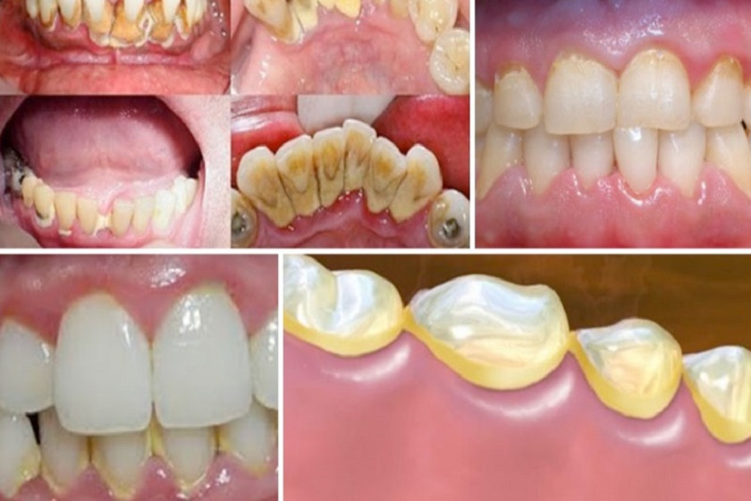 Cạo vôi răng tại nha khoa