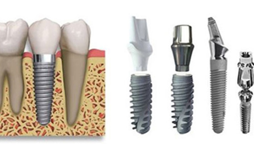 Cần hỏi: Thời gian làm răng Implant Pháp được bao lâu?