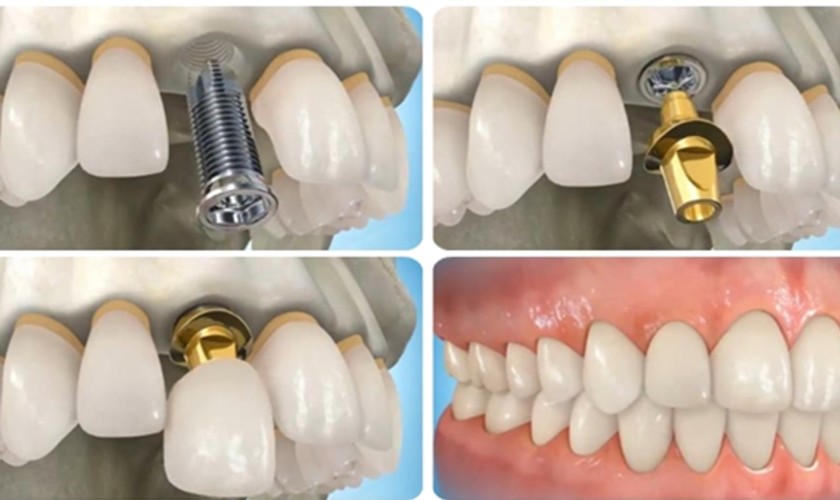 Trồng răng Implant Pháp tại nha khoa Nhân Tâm