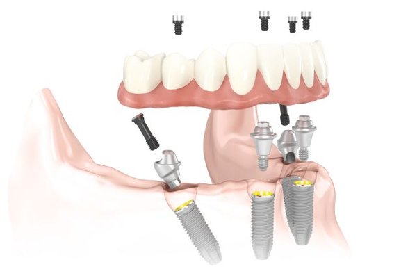 Implant All on 4 - Giải pháp phục hồi răng toàn hàm ưu việt