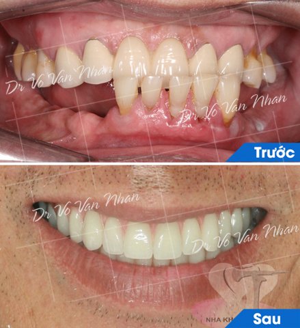 Implant All on 4, phục hình răng toàn hàm, mang lại khả năng ăn nhai chắc chắn cho người cao tuổi