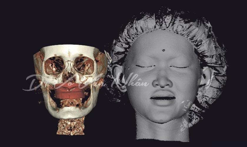 Implant cá nhân hóa được chỉ định cho các trường hợp tiêu xương nghiêm trọng Implant cá nhân hóa được chỉ định cho các trường hợp tiêu xương nghiêm trọng