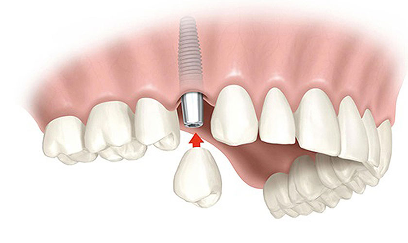 Trả lời cho câu hỏi cấy ghép răng Implant Pháp có mấy loại, implant của hãng Tekka được chia riêng thành năm loại 
