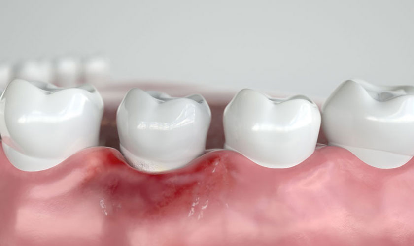 Liên hệ nha khoa Nhân Tâm để được giá cấy ghép răng implant Pháp tốt nhất