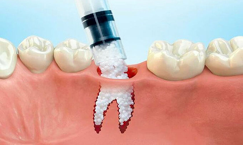 Chú ý sau khi cấy ghép xương ổ răng, để mau lành bạn sẽ cần tuân thủ theo căn dặn của bác sĩ.