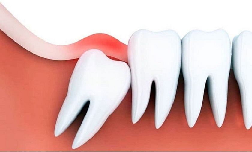 Khi nào cần cắt lợi trùm