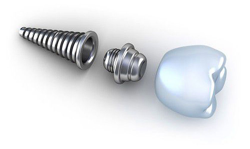 Quy trình cấy ghép Implant sẽ được thực hiện nối tiếp ngay lập tức sau nhổ răng Quy trình cấy ghép Implant sẽ được thực hiện nối tiếp ngay lập tức sau nhổ răng