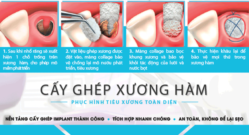 Cấy ghép xương hàm giúp phục hình tiêu xương toàn diện, trồng răng Implant thành công
