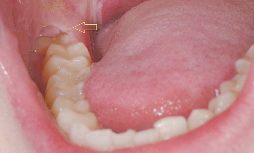 Lưu ý quan trọng khi nhổ răng số 8 Lưu ý quan trọng khi nhổ răng số 8