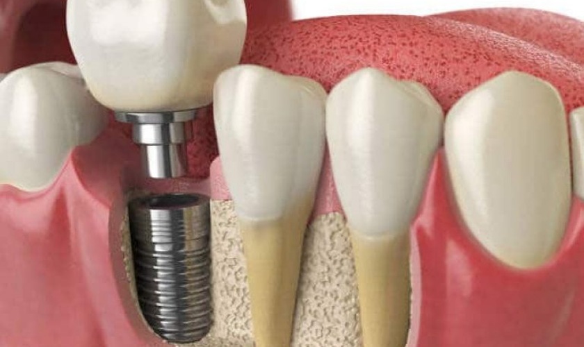Trồng răng Implant là phương pháp phục hình răng hiệu quả
