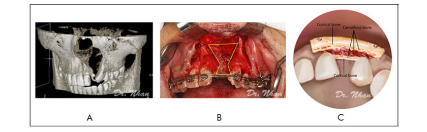 Công trình nghiên cứu của Việt Nam được đăng trên tạp chí The Cleft Palate