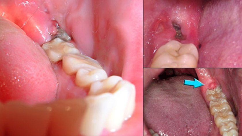 Tham khảo một số dấu hiệu nhiễm trùng sau khi nhổ răng khôn