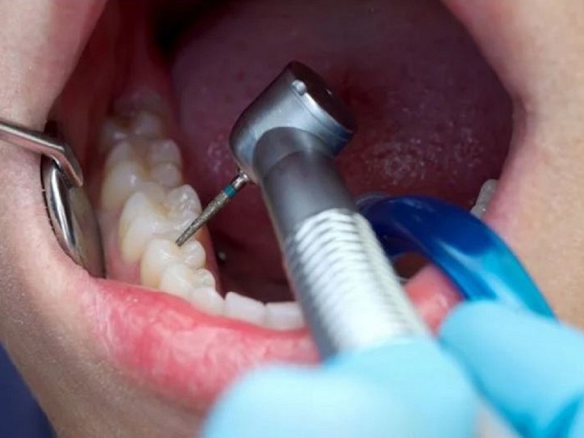 Trám răng để tránh khi bị đau răng nhẹ