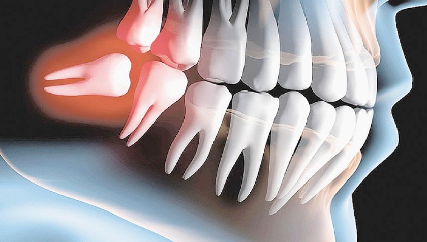 Do mọc răng khôn Do mọc răng khôn