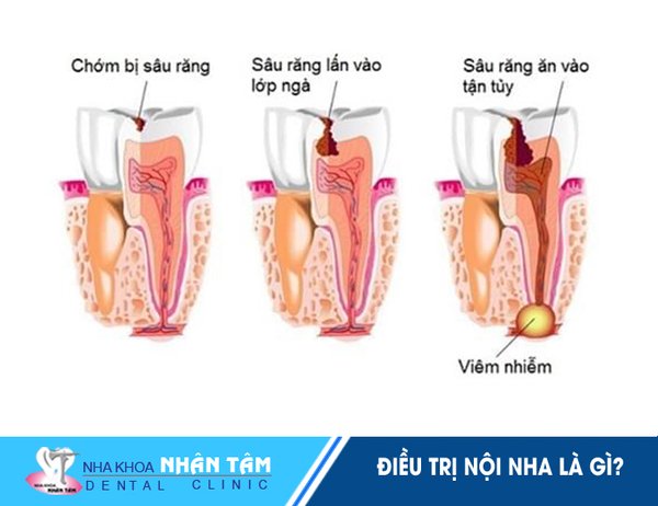 Khi tủy đã bị hỏng, tổn thương… thì cần phải điều trị nội nha