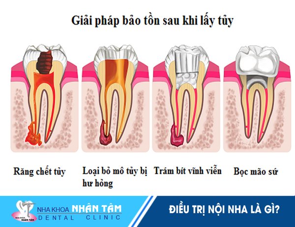 Bệnh nhân nên điều trị tủy kịp thời để có thể giữ lại chiếc răng