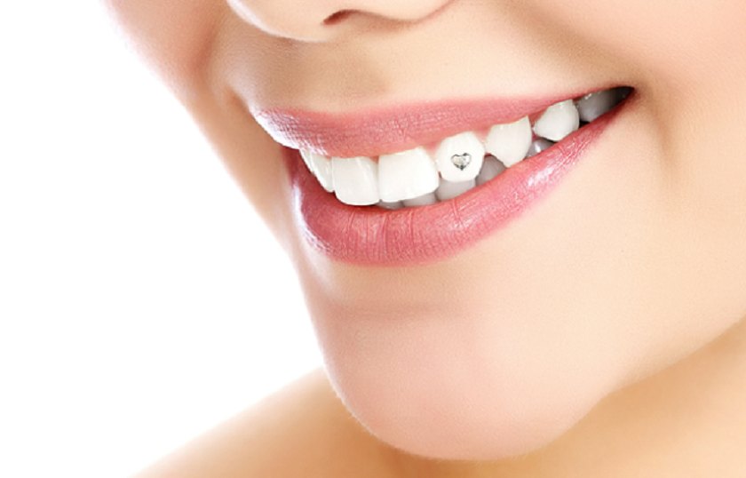 3 bước đính kim cương vào răng