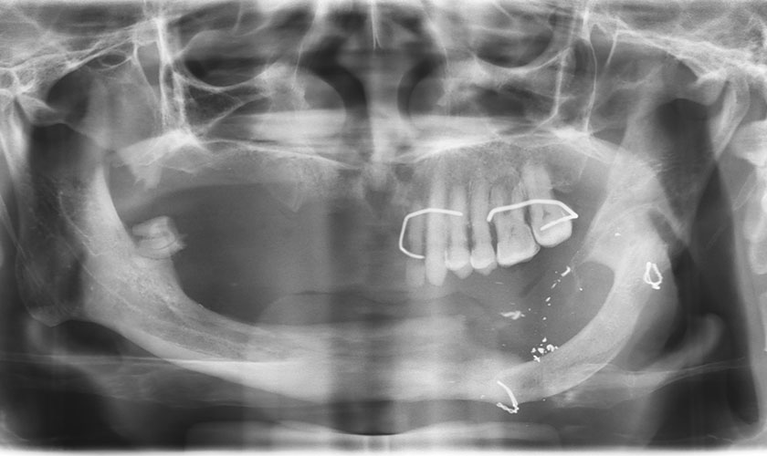 Hình chụp Xquang Panorex của bệnh nhân