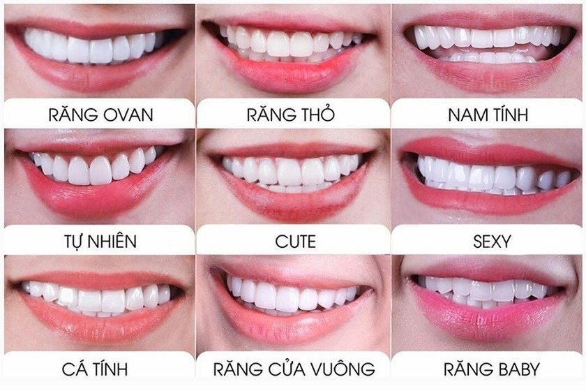 Các dạng form răng đẹp phổ biến nhất là gì?
