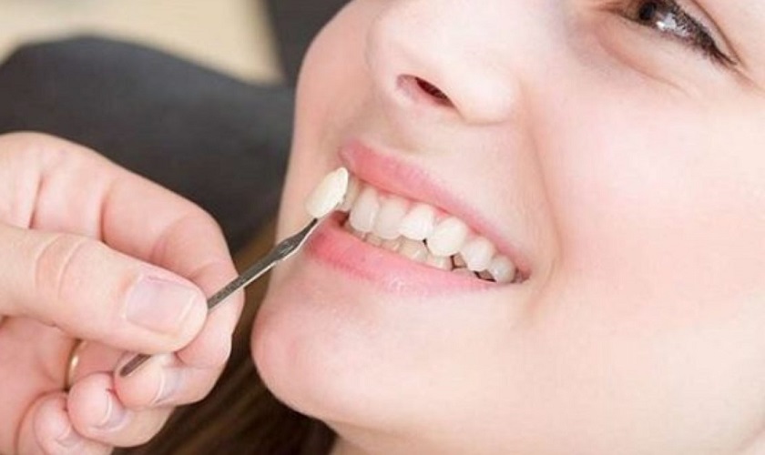 Gắn răng khểnh và những điều bạn cần nên biết