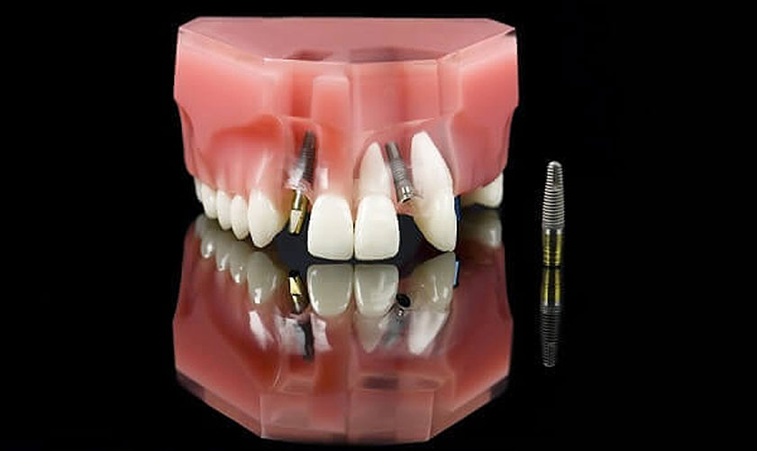 Giá trồng răng implant là vấn đề rất nhiều khách hàng quan tâm