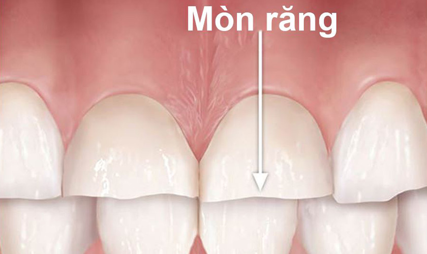 Hậu quả của Mòn răng và cách phòng tránh