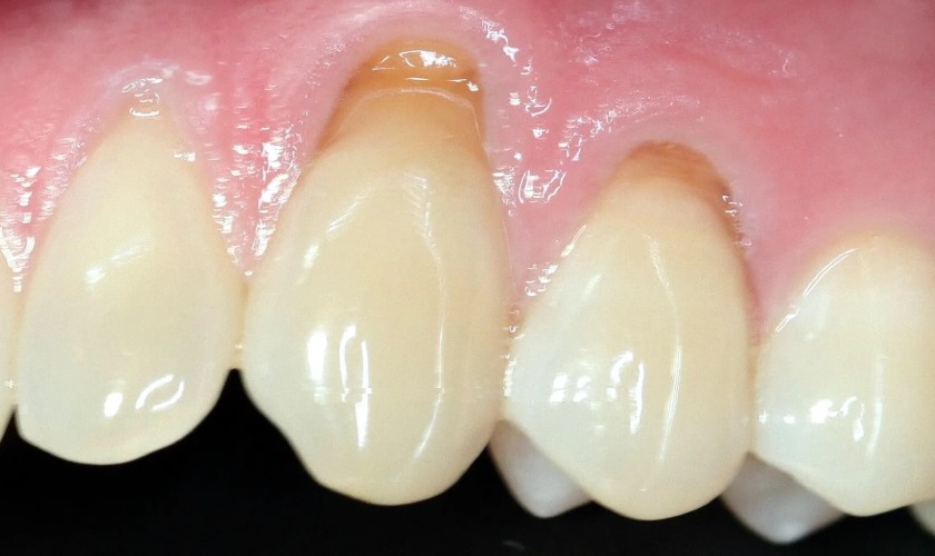 Mòn răng do nhiều nguyên nhân gây nên