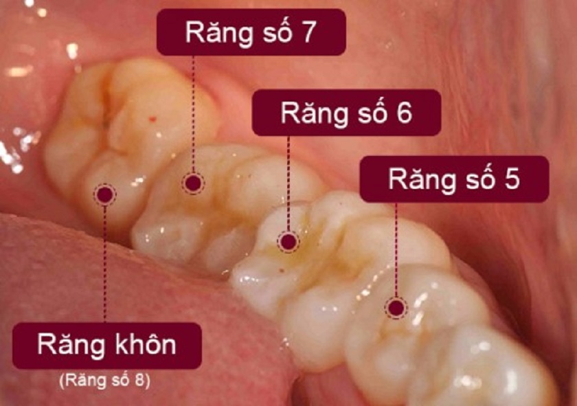 Nên nhổ răng khôn vào lúc nào? Lời khuyên từ chuyên gia nha khoa