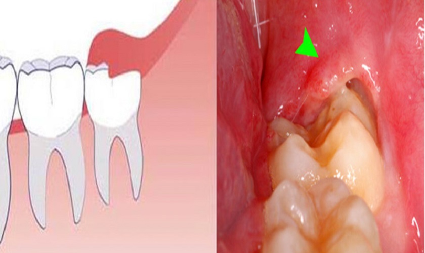 Nhổ răng khôn khi nào: Thời điểm và lưu ý quan trọng