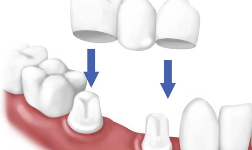 Phương pháp làm cầu răng sứ
