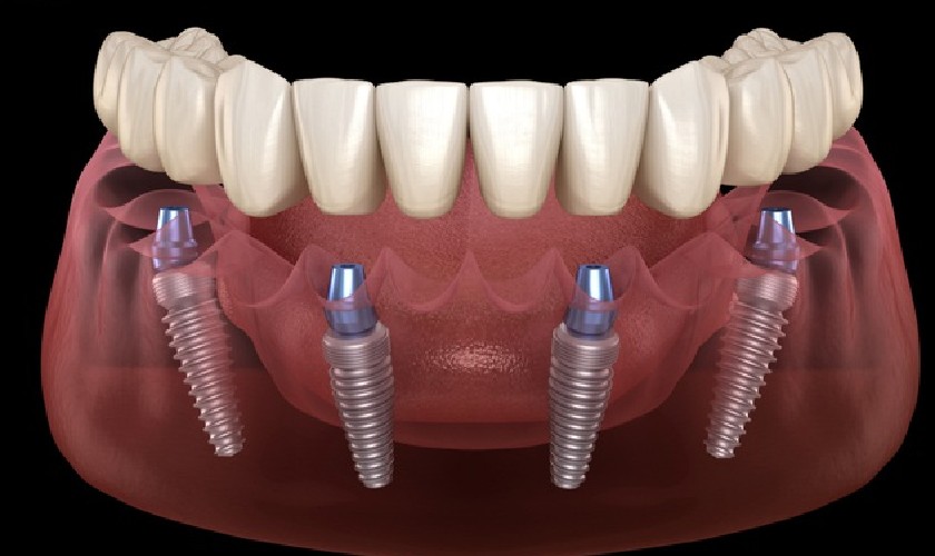 Trồng răng Implant