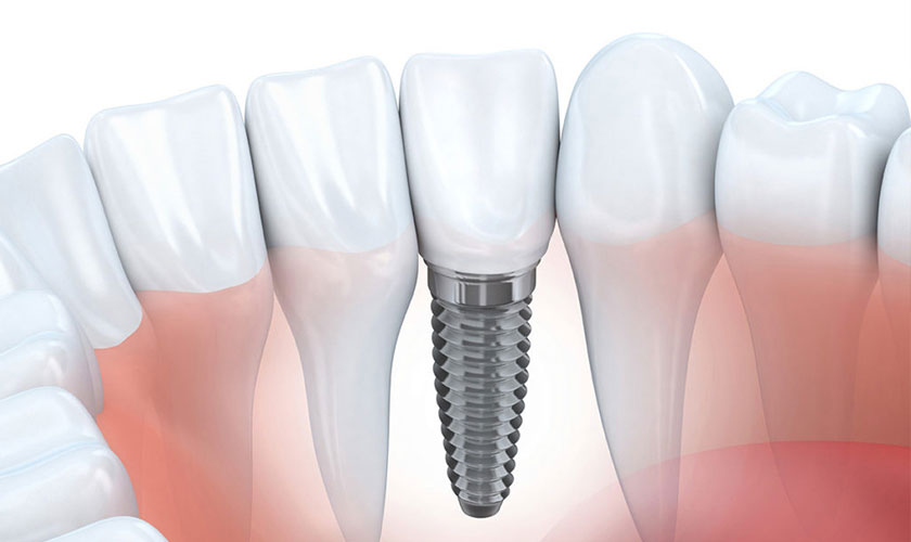 Ưu điểm làm răng Implant không chỉ nằm ở chất lượng cao mà còn có thể sử dụng trọn đời